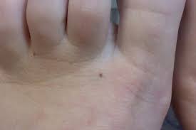 In stage 0, the melanoma is in the top layer of your skin only (called the epidermis). Melanoma Of The Foot If In Doubt Immediate Referral