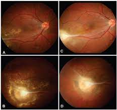 Optic Neuritis And Chorioretinitis As Ocular Manifestations Of Borreliosis In Brazil Three Cases Reported