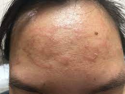 Die diagnose der pityriasis versicolor ist eine blickdiagnose, die durch den erfahrenen dermatologen ohne probleme gestellt werden kann. Bilder Von Hautpilz Kleienpilzflechte Ringelpilzflechte