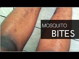 How to get rid of mosquito bites, according to marthe dika? How To Get Rid Of Hyperpigmentation Scars On Legs Mosquito Bites On Skin Skin Care Tretinoin Youtube