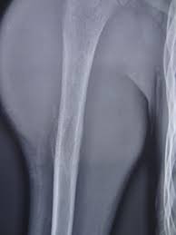 Image result for Ewing Sarcoma