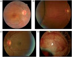 Image result for Scleritis