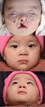 Primary Cleft Rhinoplasty with Custom Suture Needle for Alar Cartilage  Repositioning in Unilateral Cleft Lip Patients: 3D Nasal Analysis