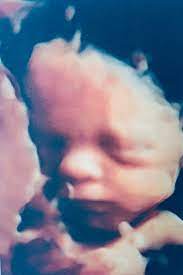 Can A 3d Ultrasound Detect Fas April 2020 Babies Forums What To Expect
