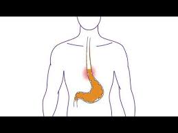 This video shows how the esophagus works and how acid can. Heartburn Causes Symptoms Relief Nexium Control
