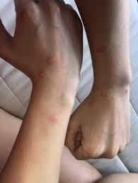 In fact, bed bug pest control services are one of the most requested services ehrlich offers and the demand seems to be growing. Bed Bug Bites 17 Bites Total On My Body These Are The Only Clusters Others Are Further Apart Pestcontrol