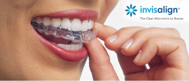Invisalign (Clear Aligners) product image
