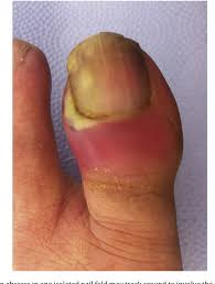 Image result for Paronychia feet