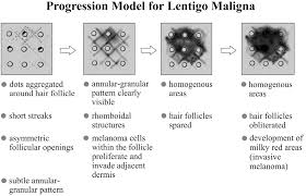 These lentigines generally occur early in life and are not ass. Pdf Dermatoscopy For Facial Pigmented Skin Lesions Semantic Scholar