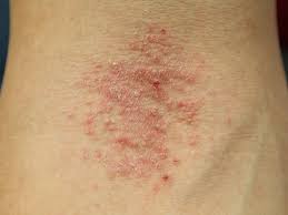 Image result for Atopic eczema atopic dermatitis
