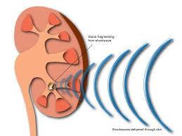 Shockwave Lithotripsy For Kidney Stones Eswl Body Tissues Stone Kidney Stones