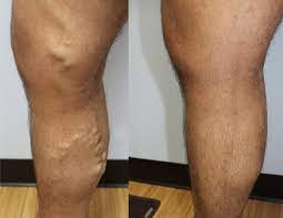 Varicose Veins Laser Treatment Peter Brukasz Md Addison Il Palos Hills Il