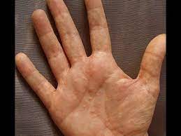 Dermatitis Or Dyshidrosis How I Prevent Getting Painful And Unsightly Summer Hands Dyshidrotic Eczema Treatment Dyshidrotic Eczema Eczema Cure