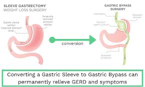 Maybe you would like to learn more about one of these? Hiatal Hernia After Gastric Bypass What It Is Complications Options