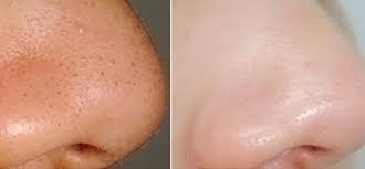 Tidak dinafikan masalah blackhead dan whitehead memang merimaskan. Bahan Bahan Untuk Hilangkan Blackhead Dan Whitehead Dunia Wanita Wanita Lelaki Forum Cari Infonet