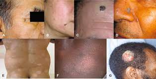 These spots can be flat or raised and can bleed easily. Skin Cancer And Photoprotection In People Of Color A Review And Recommendations For Physicians And The Public Sciencedirect
