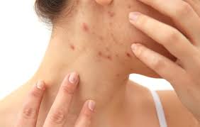 Image result for human scabies