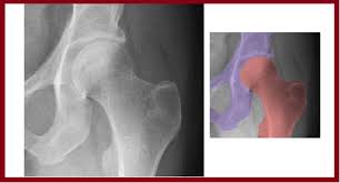 Image result for Hip XRay