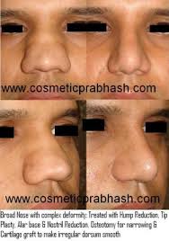 Find quick results from multiple sources. Rhinoplasty India Best Nose Job Surgery Cost Delhi Rhinoplasty Before After
