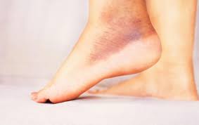 Image result for Pigment stains on the shin