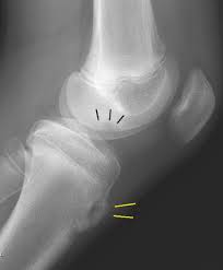 Orthokids Osgood Schlatter S Disease
