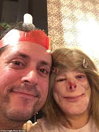 Woman whose face was burned off in house blaze reveals she has found love