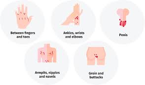 Image result for scabies symptoms