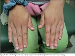 Image result for Tetany