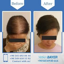 Dealing with hair loss after bariatric surgery or a significant weight loss can be common in both men and women. Fue Hair Transplant Women Before And After Picture Hair Transplant Women Hair Transplant Fue Hair Transplant