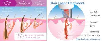 Laser hair removal was invented by dr. Laser Hair Removal Coastal Valley Dermatology