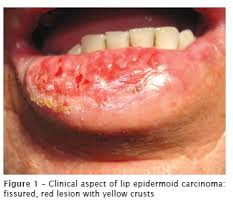 Image result for Lip Cancer