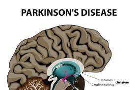 View videos on living with parkinson's off episodes today. The Cause Of Parkinson S Disease Edison Home Health Care