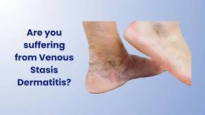 Image result for Stasis Dermatitis