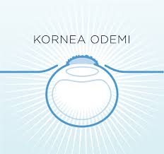 Kornea Odemi Dr Baris Sonmez Goz Hastaliklari Uzmani
