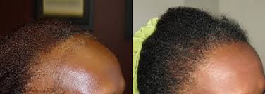 The celebrity hairtransplant before and after photos clearly reveal the reality that hair transplant can suit to people if they bother to make it happen by expert persons. African American Hair Transplant Ziering Medical Get Appointment Now