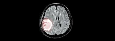 Brain tumors can effect virtually any part of a dog's personality and body. Brain Tumors In Dogs Canine Brain Tumor Symptoms Medrego Guide