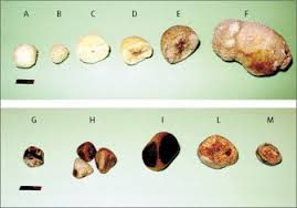 cholesterol gallstone disease sciencedirect