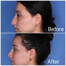 Before & After ✨ Rhinoplasty This patient underwent a rhinoplasty to refine  and balance her profile while preserving her natural beauty. The procedure  focused
