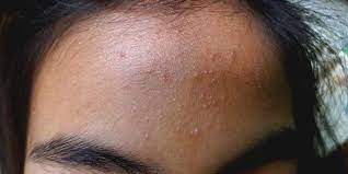 Pertama yang kita bahas adalah cara menghilangkan jerawat dengan herbal / bahan yang ada disekitar kita. Thread By Nazirahalyani 3 Cara Hilangkan Jerawat Pasir 1 Double Cleansing Gunakan Cleanser Yg Mempunyai