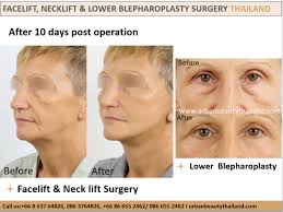 This procedure is generally more common than a full facelift and is primarily designed to assist in the correction of any wrinkles and sagging that exist around the lower portion of the face. Mini Facelift Quicklift Weekend Facelift Thailand Cost Urban Beauty Thailand