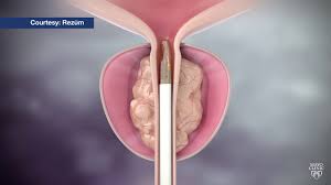 Mayo Clinic Minute Steam Treatment For Enlarged Prostate Youtube