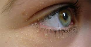 I Used To Have These Strange Bumps Around My Eyes Until I Learned This Brilliant Trick White Bump On Eyelid Skin Care Remedies Pimple On Eyelid