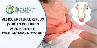 Image result for Pediatric Reflux