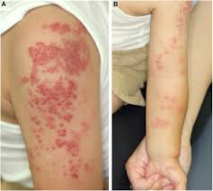 Image result for Varicella zoster on human skin