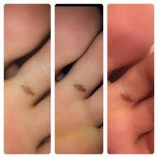Malignant melanoma is one of the deadliest skin cancers known. Mole On Toe Melanoma