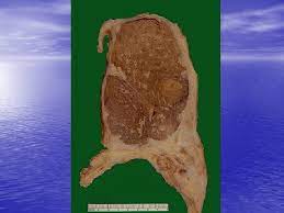 Accumulations and deposits the pathology guy. Tumors Of Lung And Pleura Tumors Of The