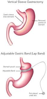 Weight Loss Surgery 318 Forum Magazine