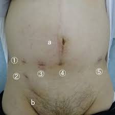 In an inguinal hernia, abdominal fat or a loop of small intestine enters the inguinal canal, a tubular in men, inguinal hernias typically develop in the groin area near the scrotum, on one or both (double. Totally Extraperitoneal Inguinal Hernia Repair During Extraperitoneal Laparoscopic Radical Prostatectomy Report Of A Case Sciencedirect