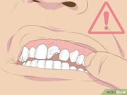 Always remove them when eating or drinking. 3 Ways To Make Fake Braces Or A Fake Retainer Wikihow