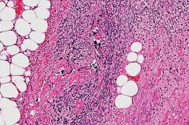 Necrotizing fasciitis is a rare infection that spreads along the superficial fascia, compromising the subcutaneous tissue between the skin and underlying muscle. Prognostic Factors Evaluated For Synchronous Multifocal Necrotizing Fasciitis Microbiology Labmedica Com